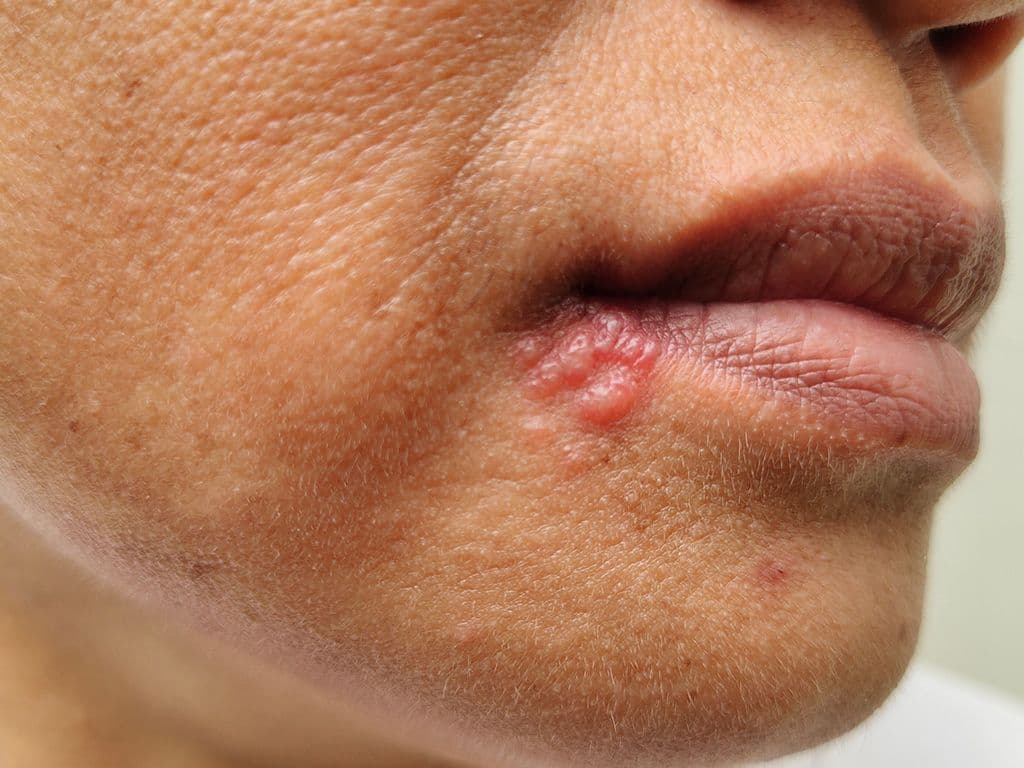 Hoe heet de seksueel overdraagbare ziekte waarbij blaasjes komen op de genitaliën en de lippen?